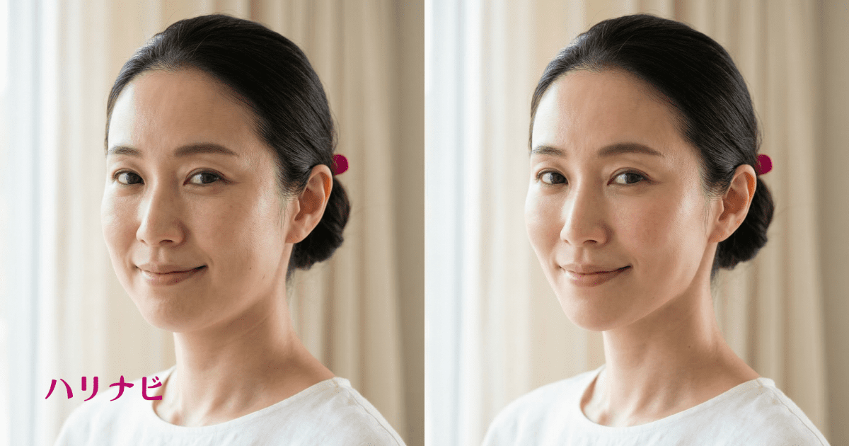 美容鍼施術後に血流が改善されてむくみが解消されたフェイスラインの変化