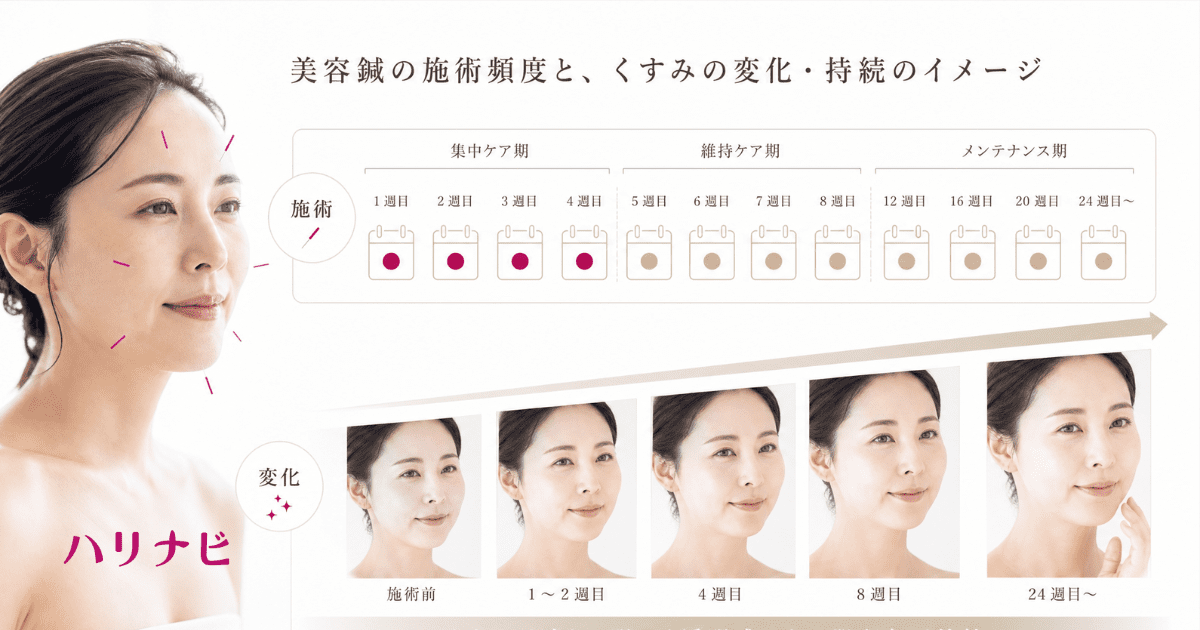 美容鍼の施術頻度とくすみの変化・持続のイメージ図