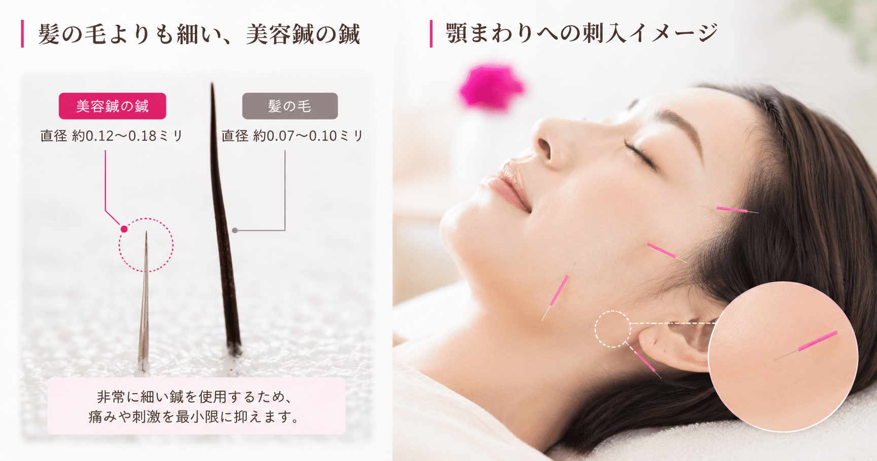 髪の毛の細さと比較した美容鍼の鍼を示す拡大イメージと、顎まわりへの刺入イメージ
